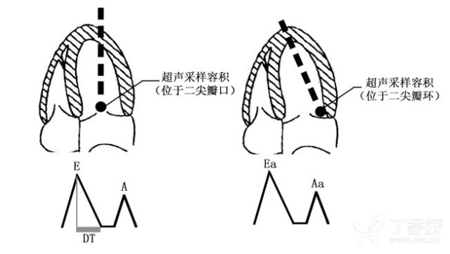 手把手教你解读超声心动图报告单