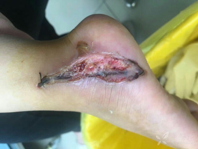 挤伤,不愈合 [病例帖]