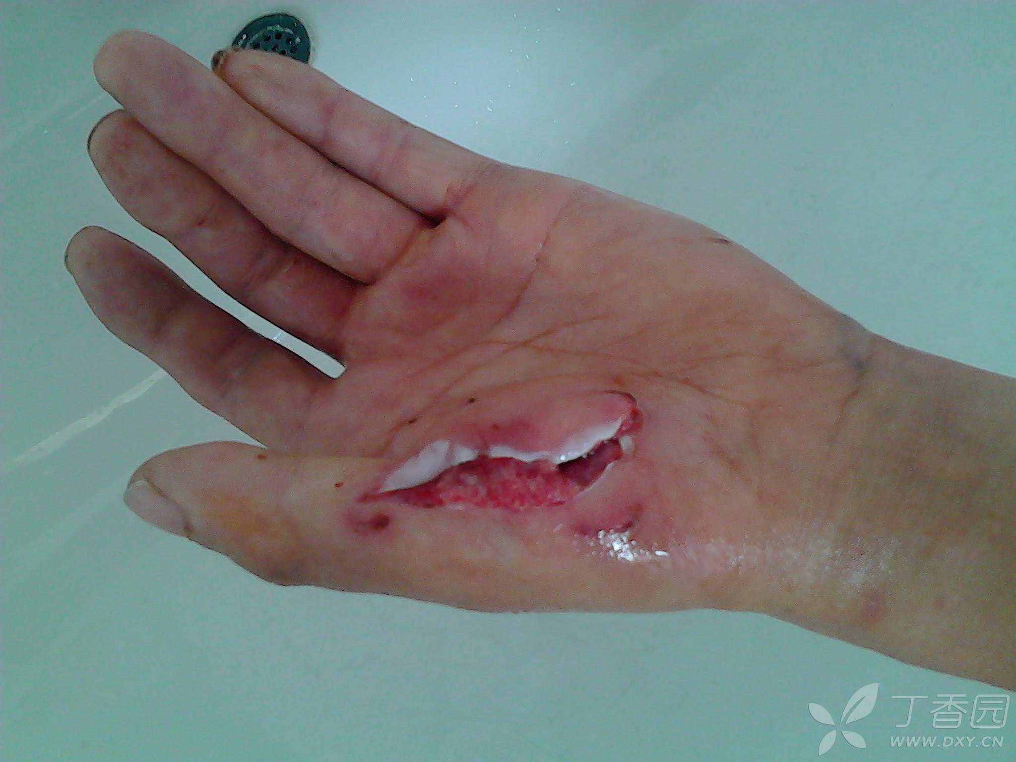 狗咬伤暴露分级和处理原则!