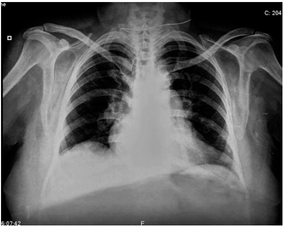 肺栓塞的三大临床表现 包虫囊肿引起肺栓塞  这个病例你或许没见过