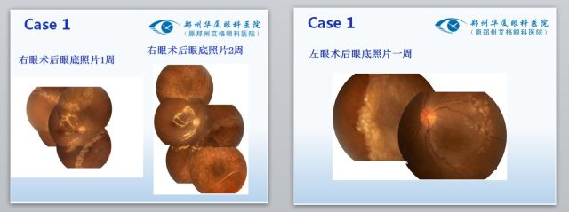 眼科专家门愿如：艾滋病玻璃体视网膜病变的手术治疗