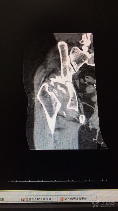 稳定性骨折需要手术吗 3226674961139163942-16w.jpg