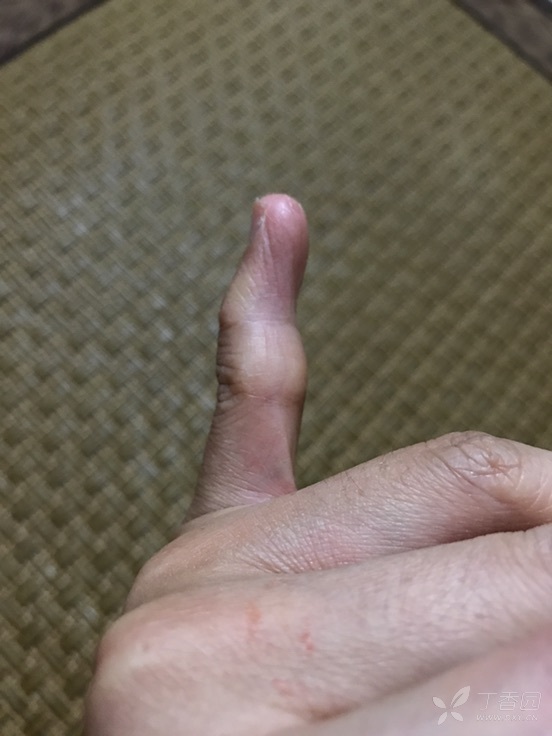小拇指天生内弯的原因图片
