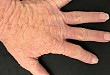 病例挑战：白癜风患者出现手背多发丘疹