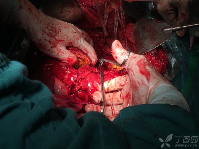 肝巨大肿块离体肝切除 自体肝移植一例 - 好大夫在线