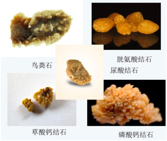 磷酸钙占据了大半壁江山 70%～80%,鸟粪石(感染性磷酸铵镁结石)5%～5%