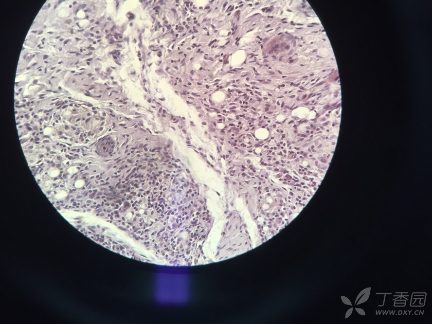 破骨细胞trap染色鉴别?