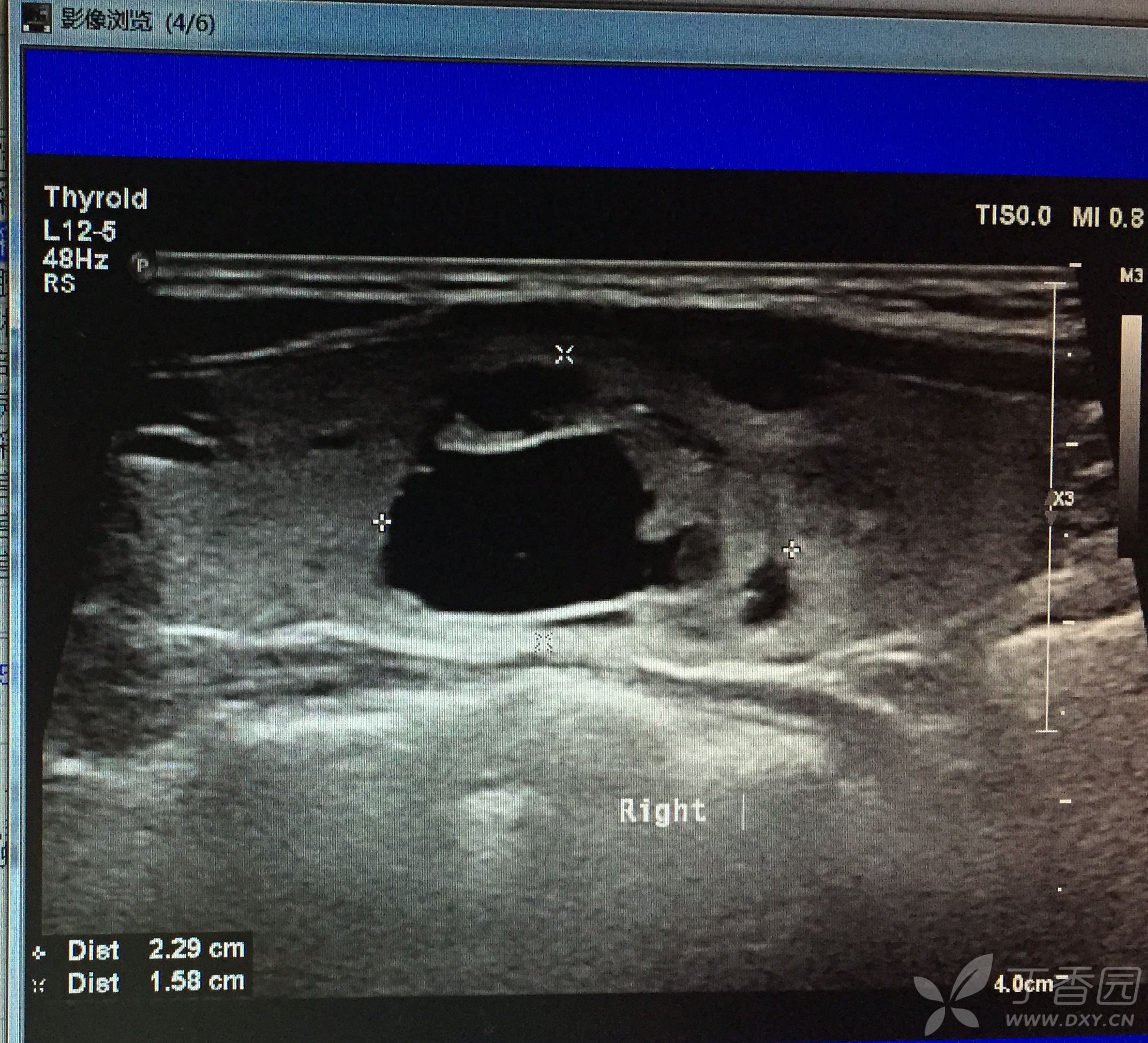 超声培训学习总结day16——结节性甲状腺肿,桥本甲状腺炎