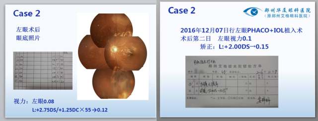 眼科专家门愿如：艾滋病玻璃体视网膜病变的手术治疗