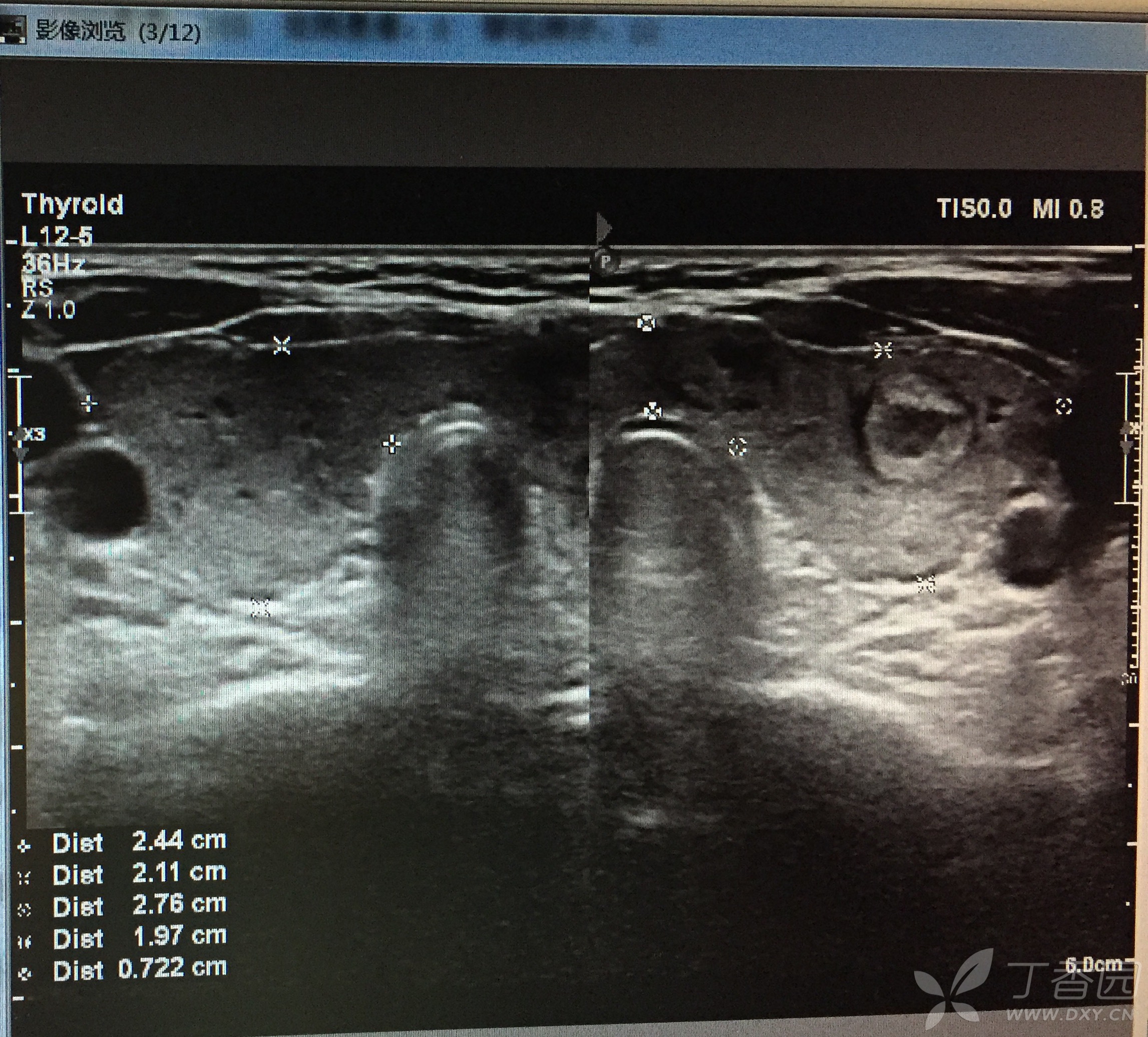 超声培训学习总结day16——结节性甲状腺肿,桥本甲状腺炎