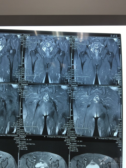 患者自诉4月前无诱因出现下蹲起身时左侧髋关节刀割样疼痛,牵涉左侧