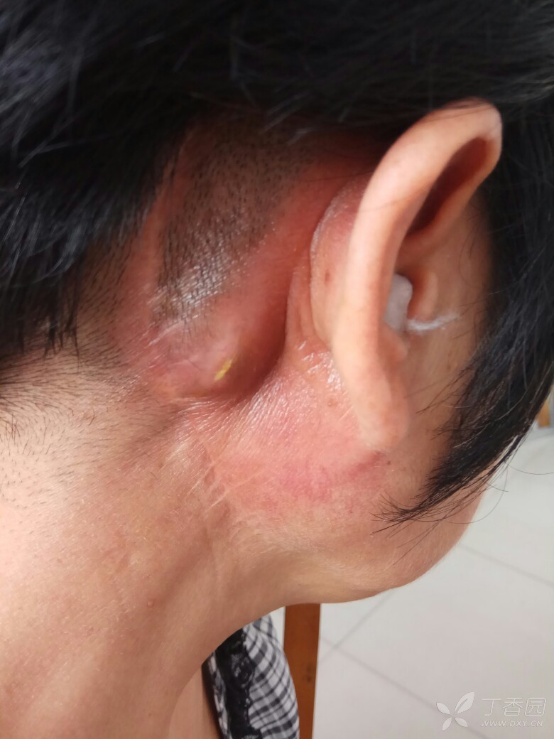 右颈静脉瘤术后10年 [病例帖]