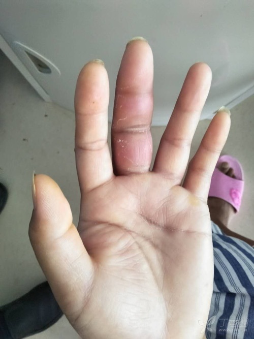 手掌,中指红肿一例,如何考虑诊断?