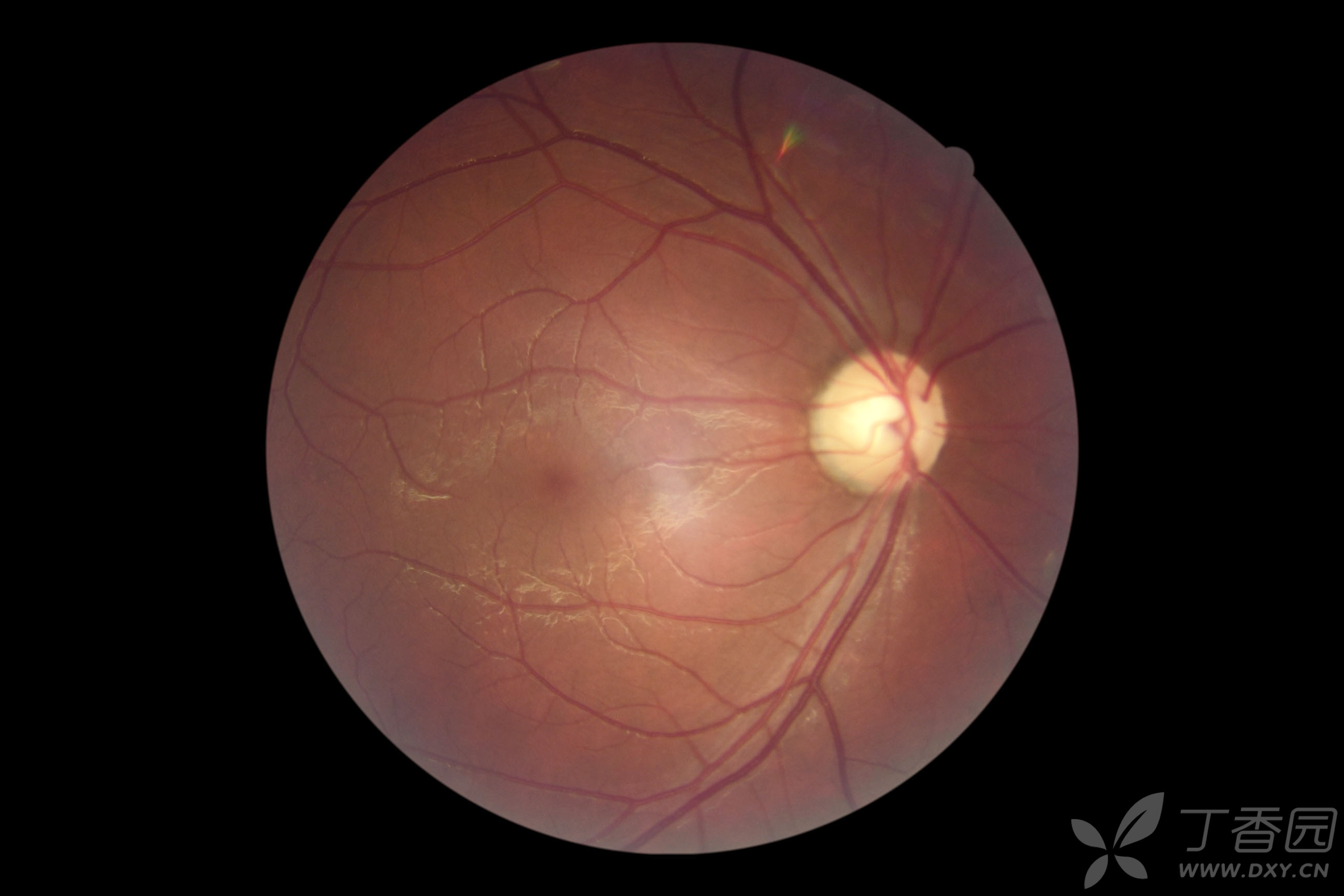 右眼视力突然下降1月余