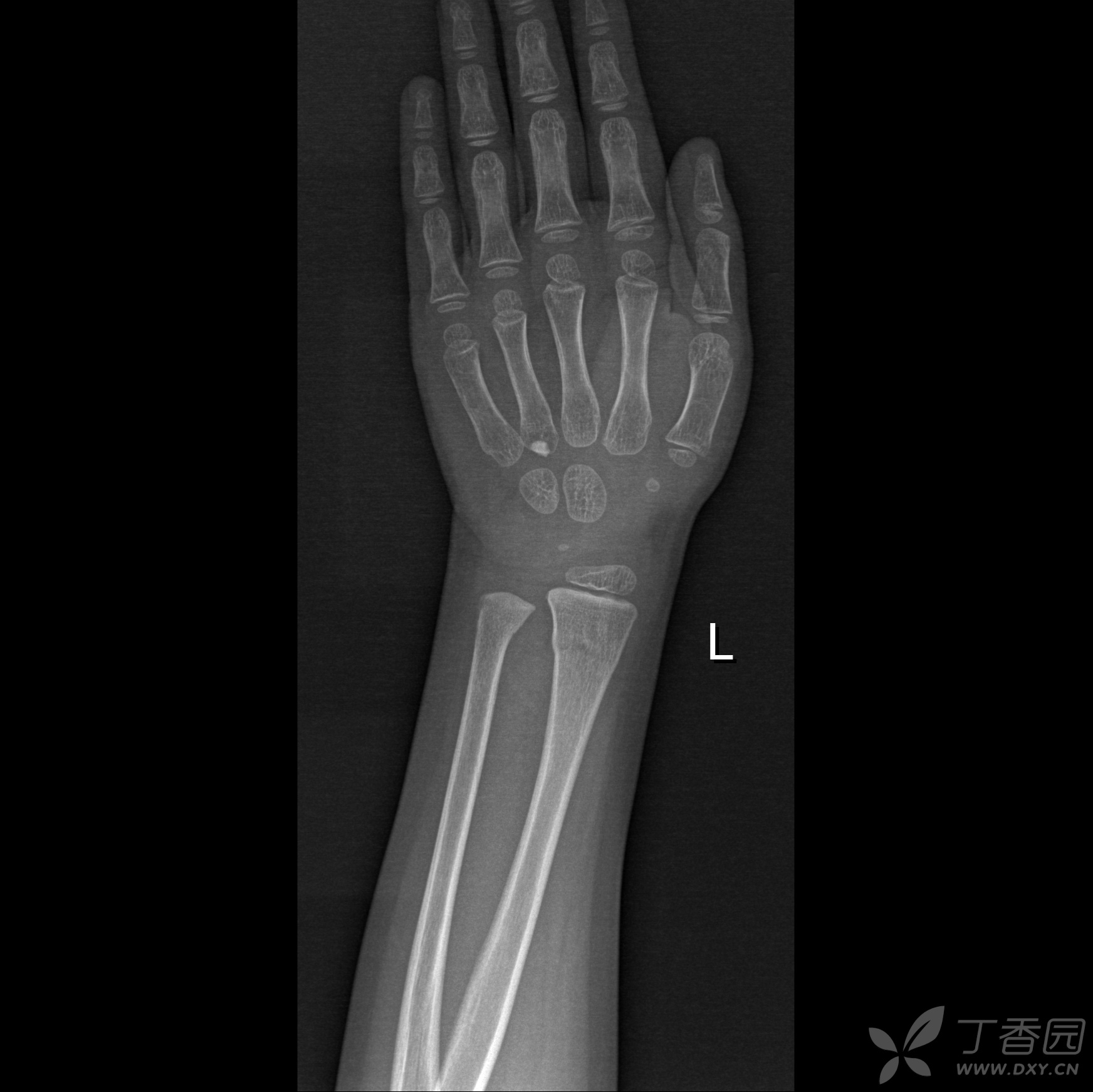 病例2:男,18岁,左腕部外伤后疼痛功能障碍1 天