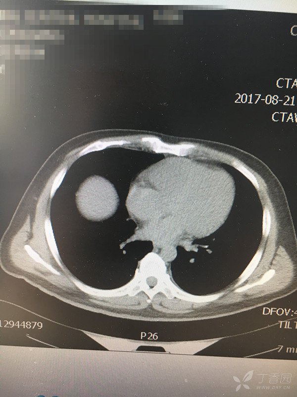 大家一起来看看这个肺CT是什么病?一周后揭晓