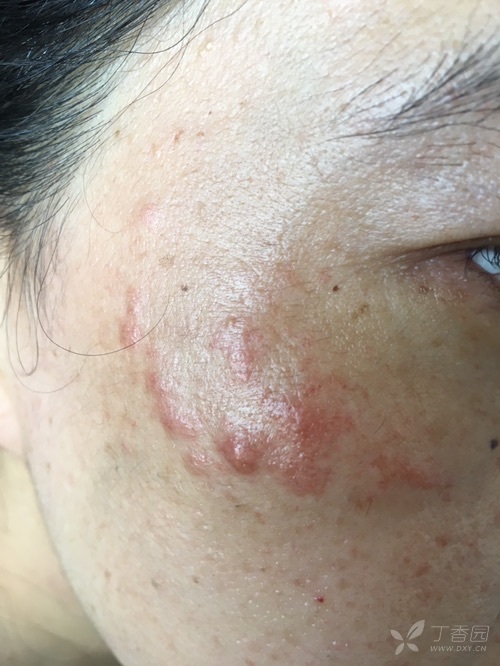 曾做过激光和光子治疗,无效.各位有何高见?