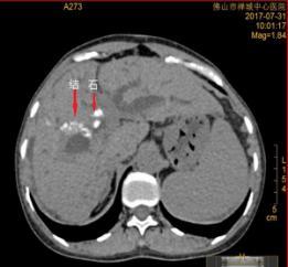 肝胆管扩张 实例展现：一期扩张法经皮经肝胆道镜取石术