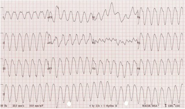 房颤心电图 室上速图片