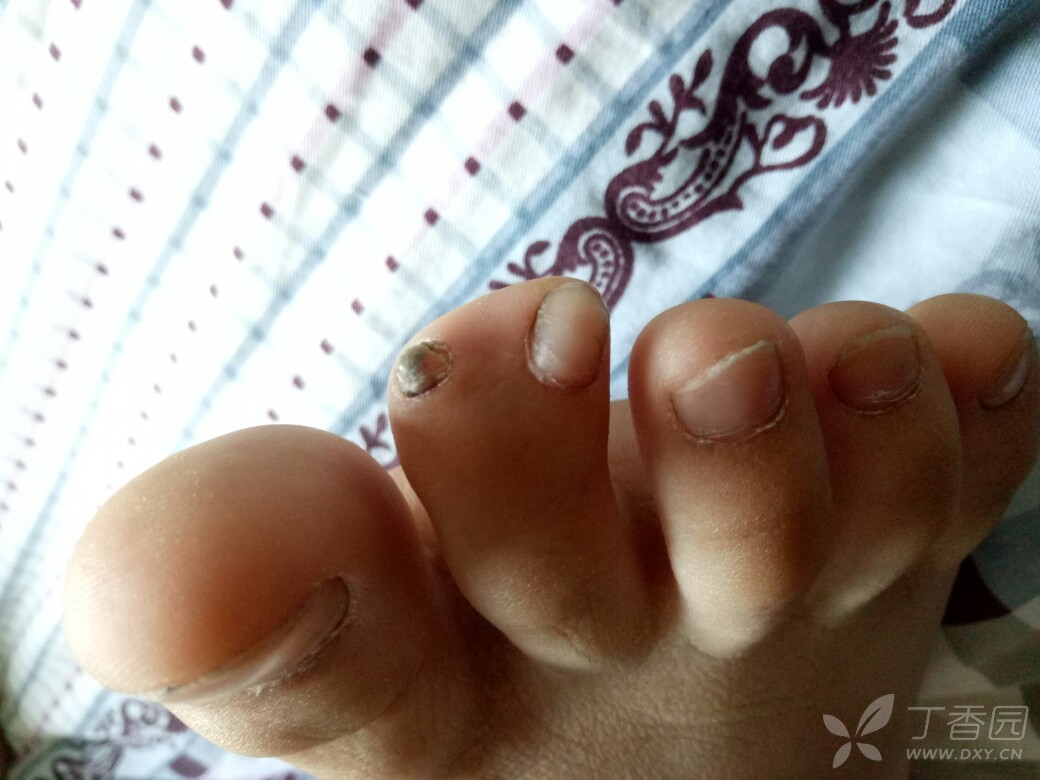 指甲先天畸形,后发黑