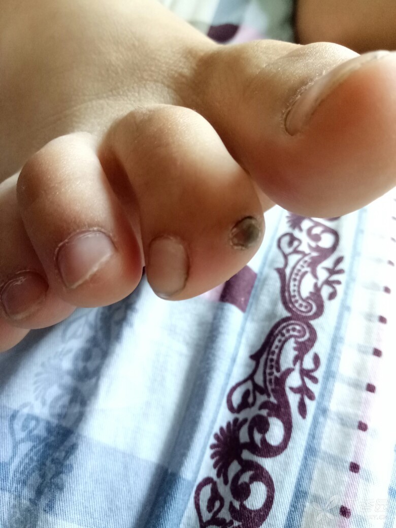 指甲先天畸形,后发黑