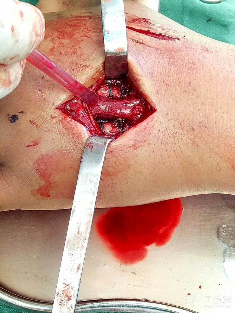 掌骨干长斜形骨折,缝线捆扎固定,请战友们拍砖! [病例帖]