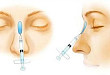病例学习：注射式隆鼻术致眼动脉分支血管栓塞