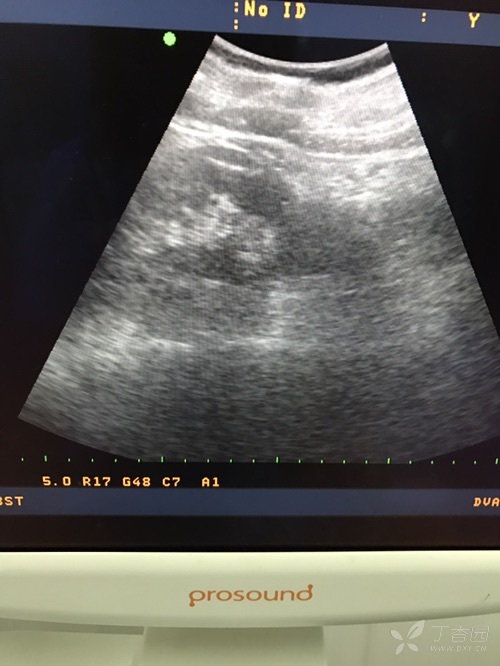 外伤,一米多摔倒,肾区不痛