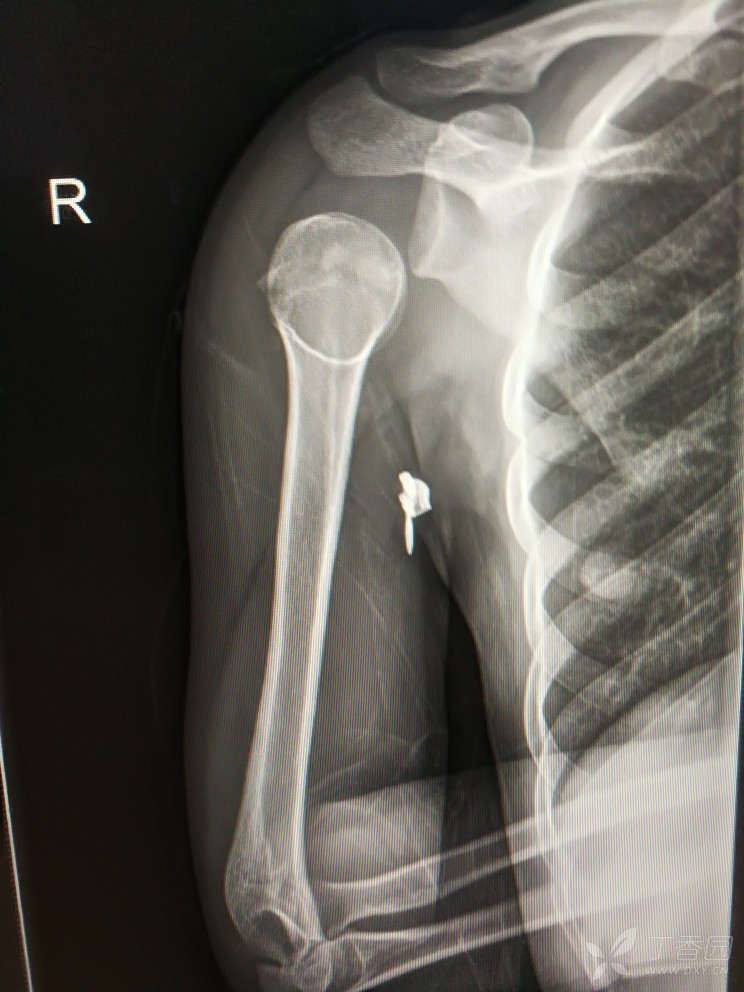 右肩膀骨折的片子照片图片