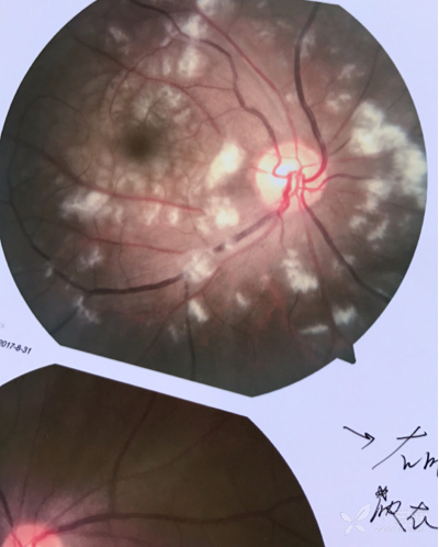 眼底棉绒斑图片图片