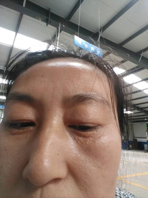 下眼睑皮疹,大家看看怎么治 [病例帖]
