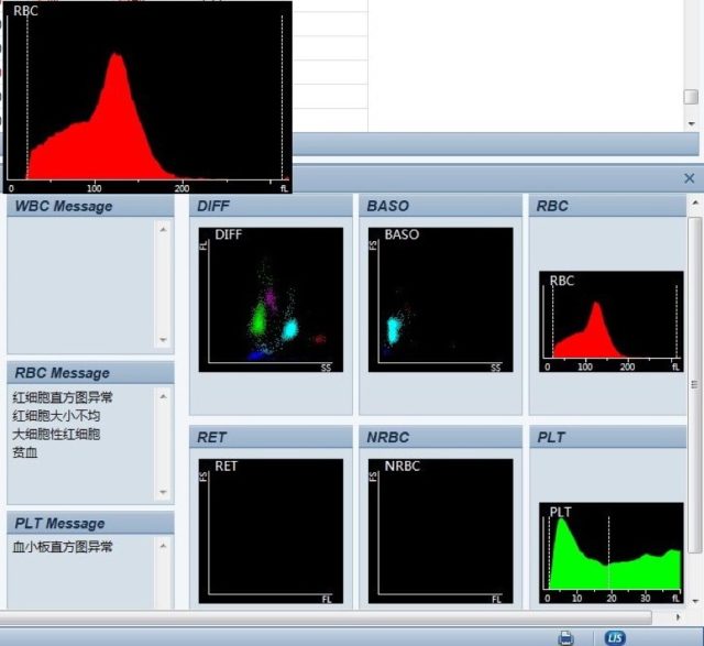 3个案例手把手教你看懂血小板直方图