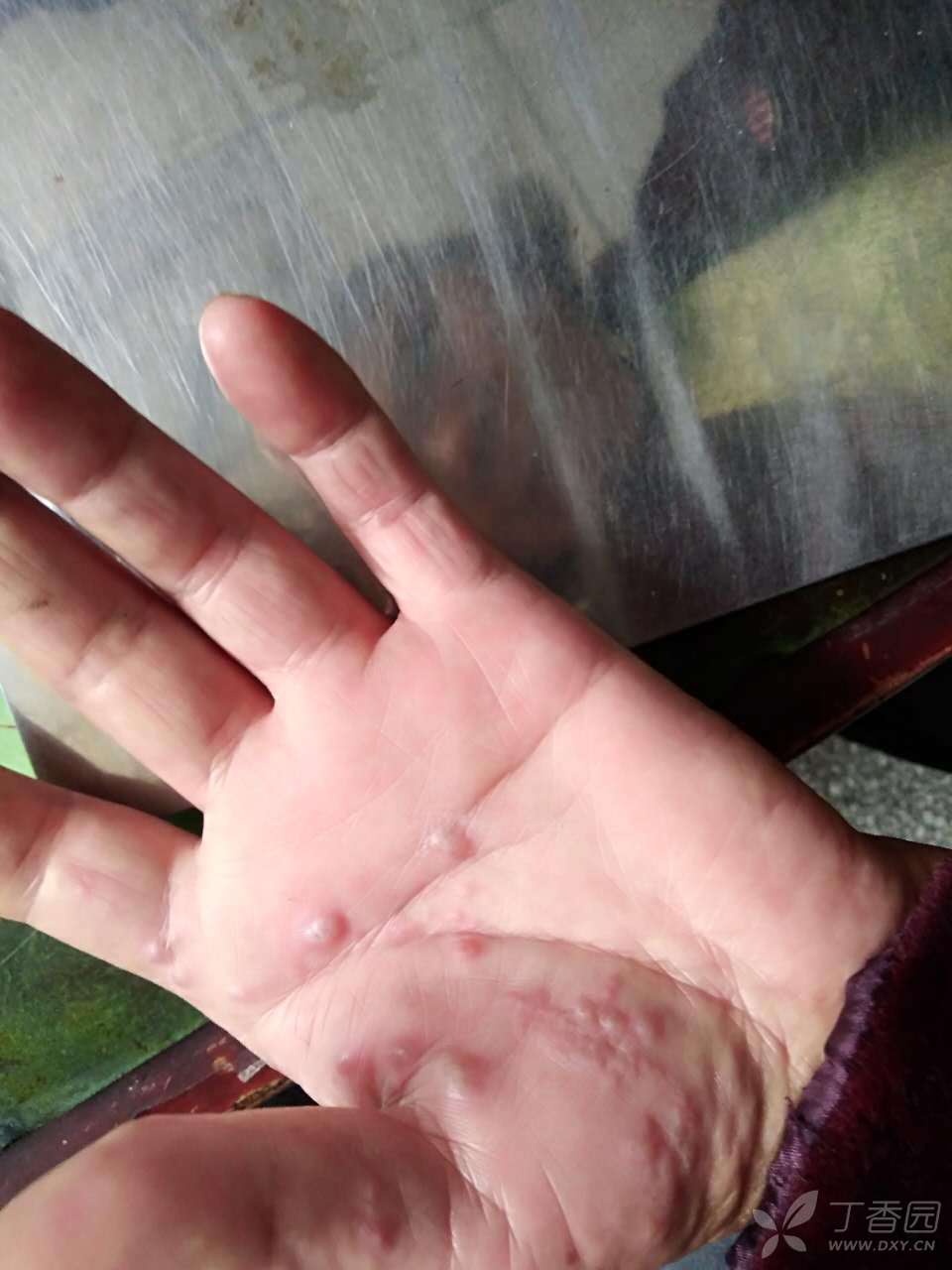 手部带状疱疹还是手癣
