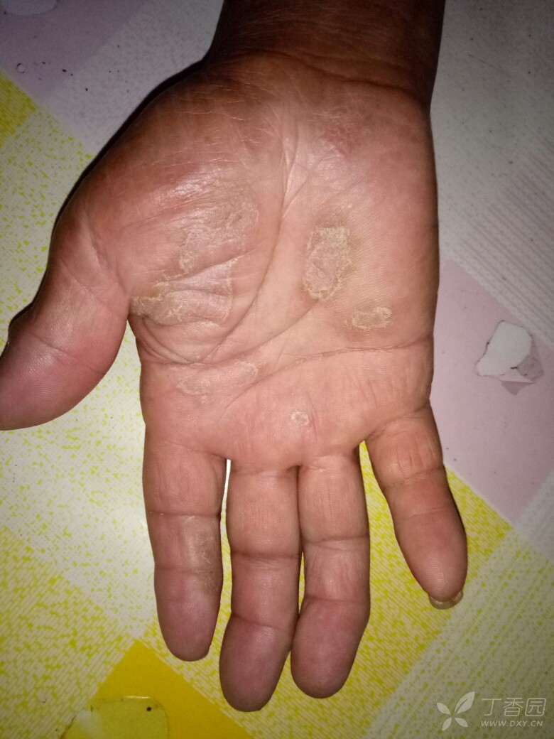 湿疹?真菌感染? [病例帖]