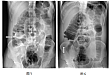 动态 DR 在肠套叠空气灌肠整复术中的优势
