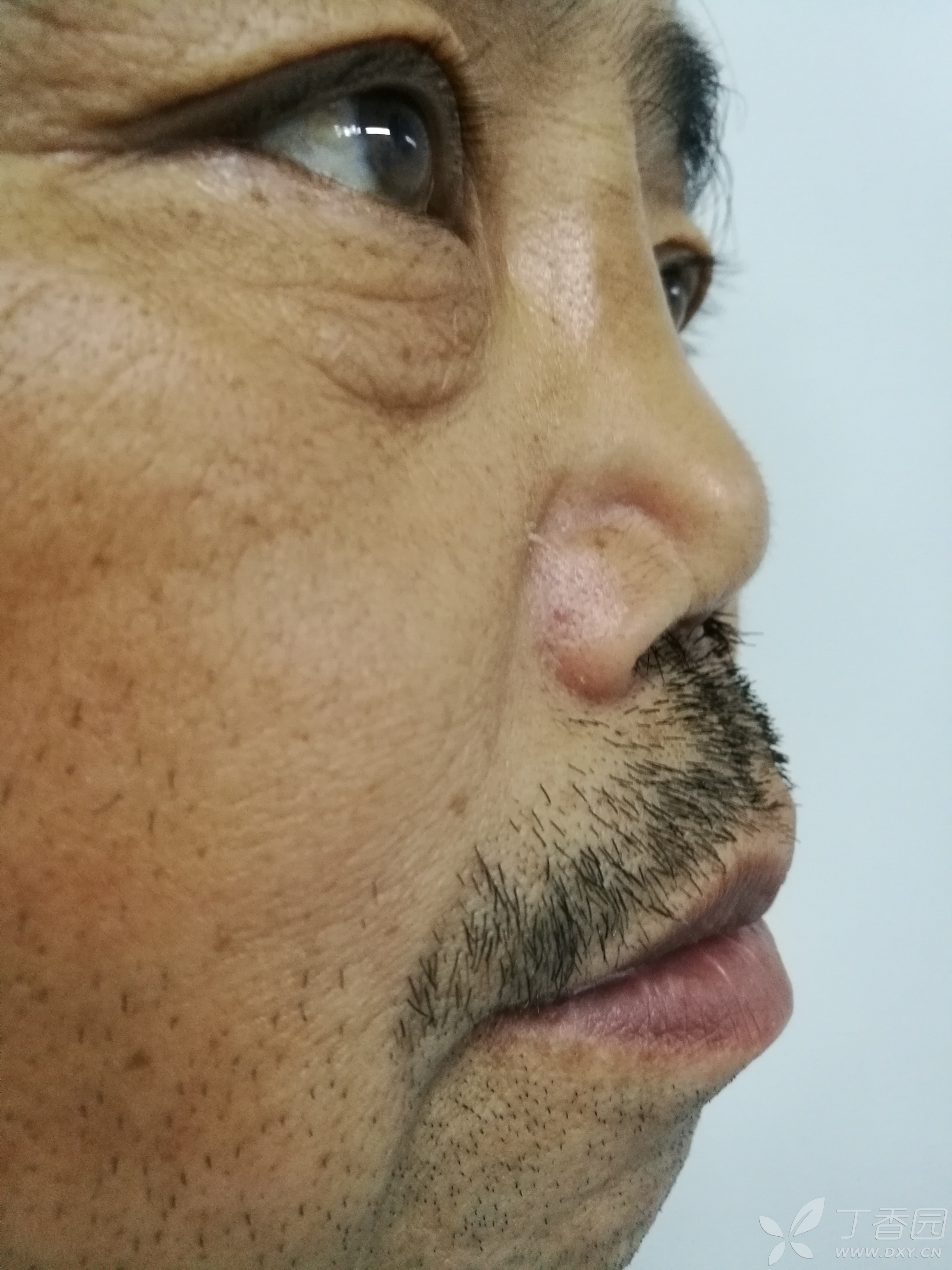 【讨论】这样的鼻子该如何修整? [病例帖]