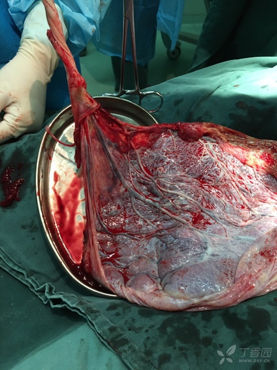 帆状胎盘前置血管图片图片