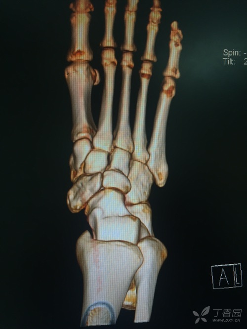 正常的足舟骨图片图片