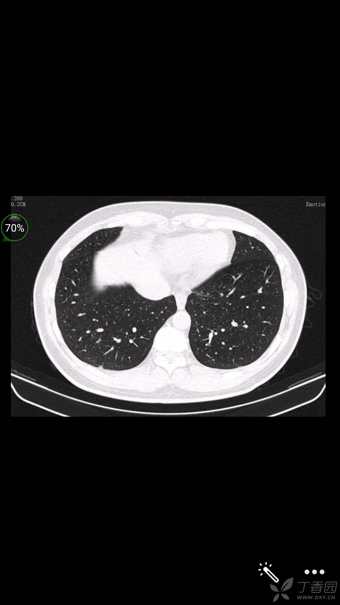 右肺中叶胸膜下结节,巨恐,请大咖帮忙分析下