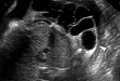 胎儿淋巴畸形：典型及非典型的超声表现