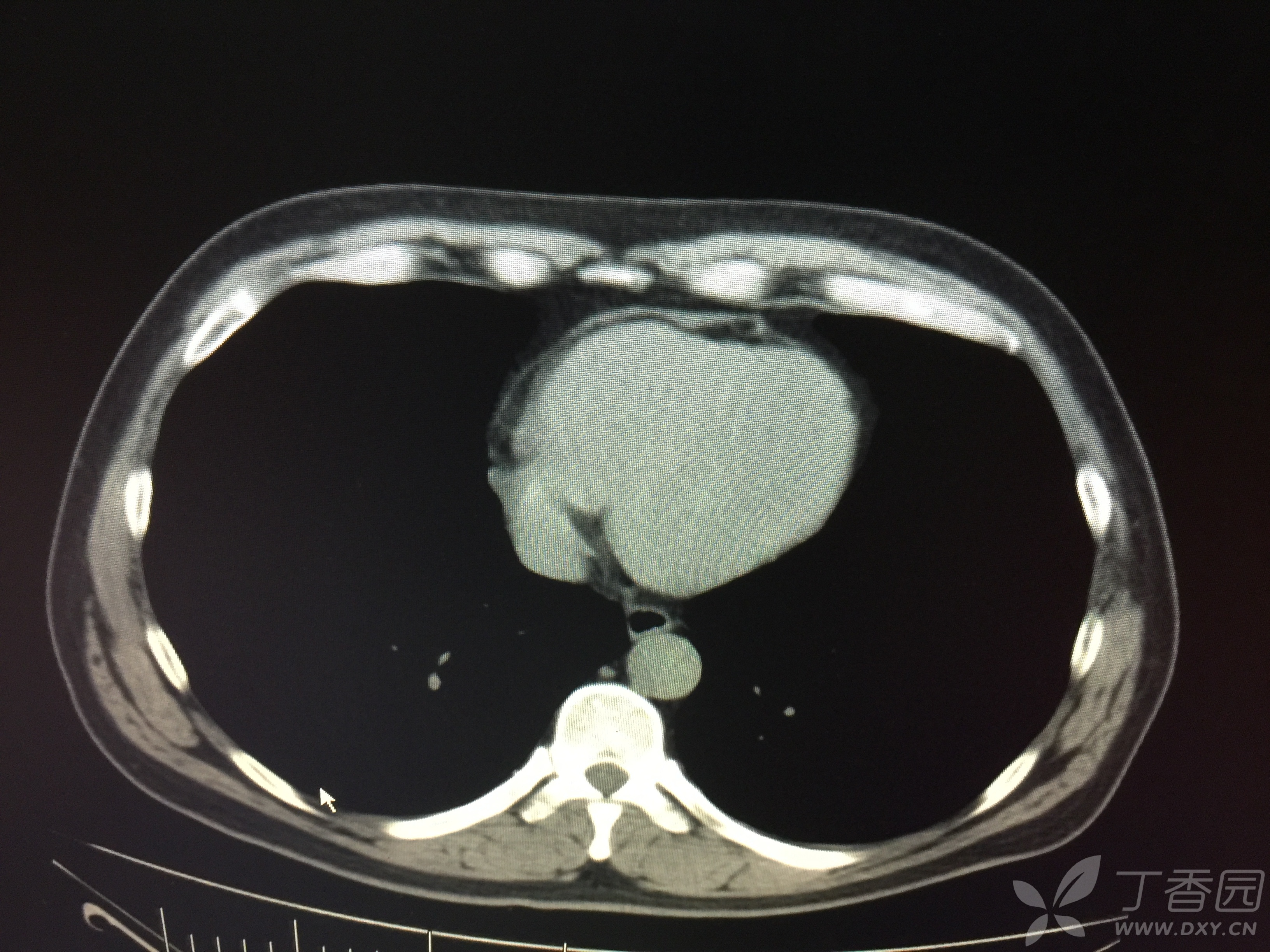 心包隐窝积液CT图片