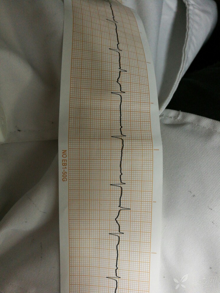 相关疾病: 房性期前收缩  室性期前收缩      