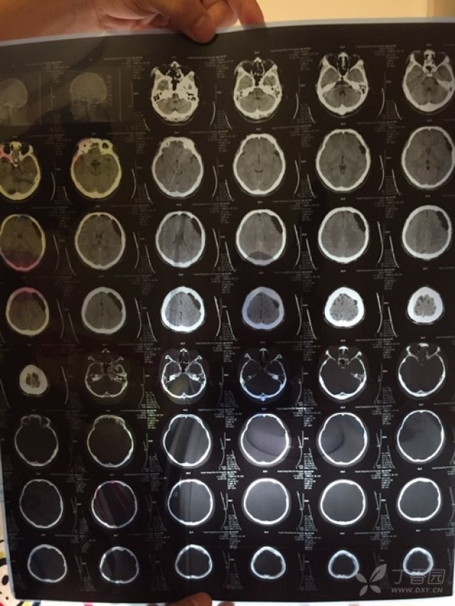 239天前     男 29岁 无头疼症状 一次摔跤做的ct.请各位指点.