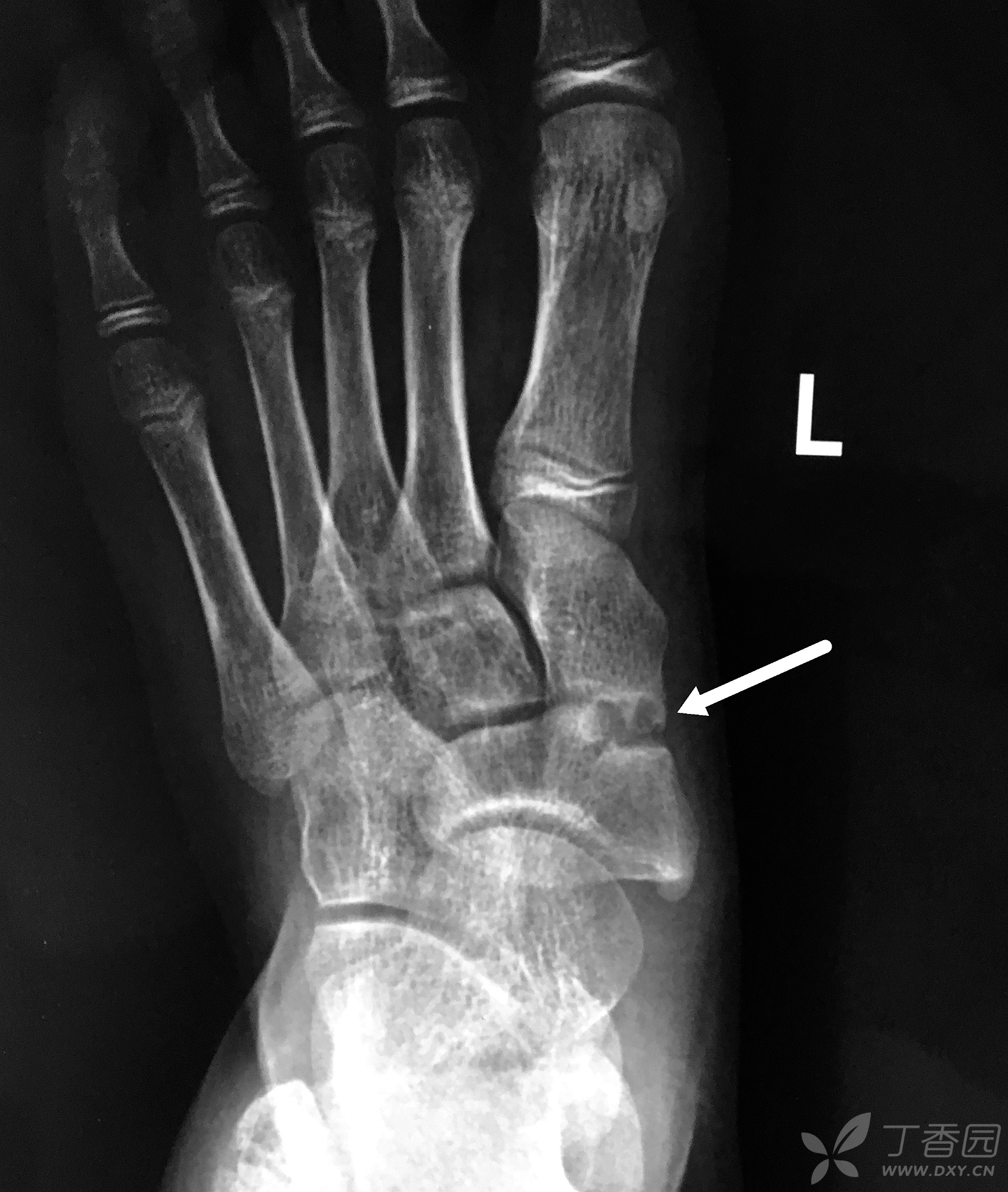 左脚骨头图图片
