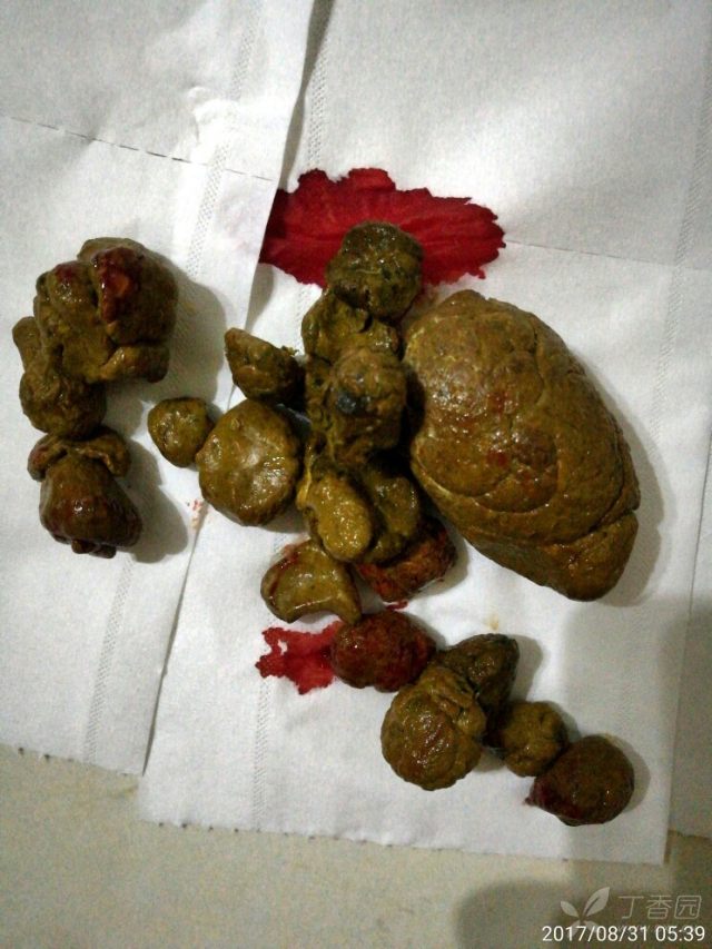 大便前段结节状,略带白色粘液.急解 [病例帖]
