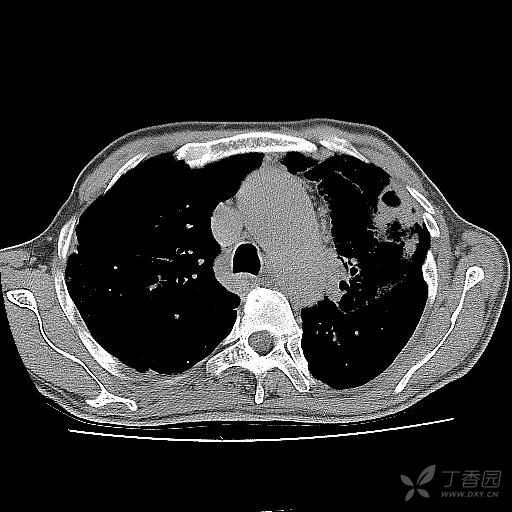 肺功能差的人有哪些症状 3232791421917889592-8w.jpg