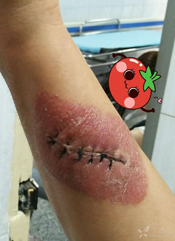 碘伏过敏一例,请大家来谈谈治疗方案!