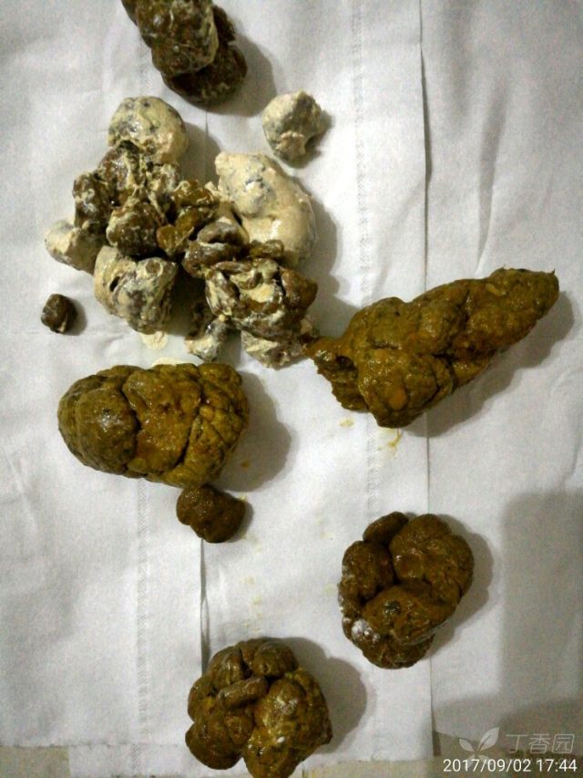 大便前段结节状,略带白色粘液.急解 [病例帖]