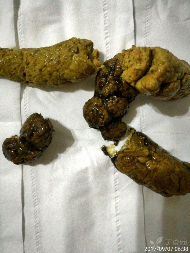 大便前段结节状,略带白色粘液.急解 [病例帖]