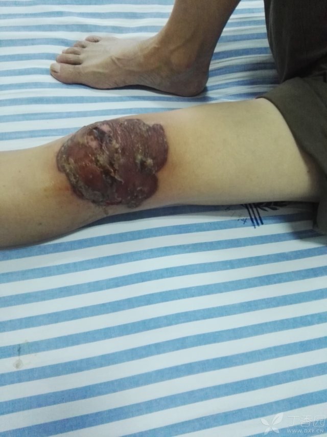 ...导致死亡,外敷威灵仙导致皮肤溃烂